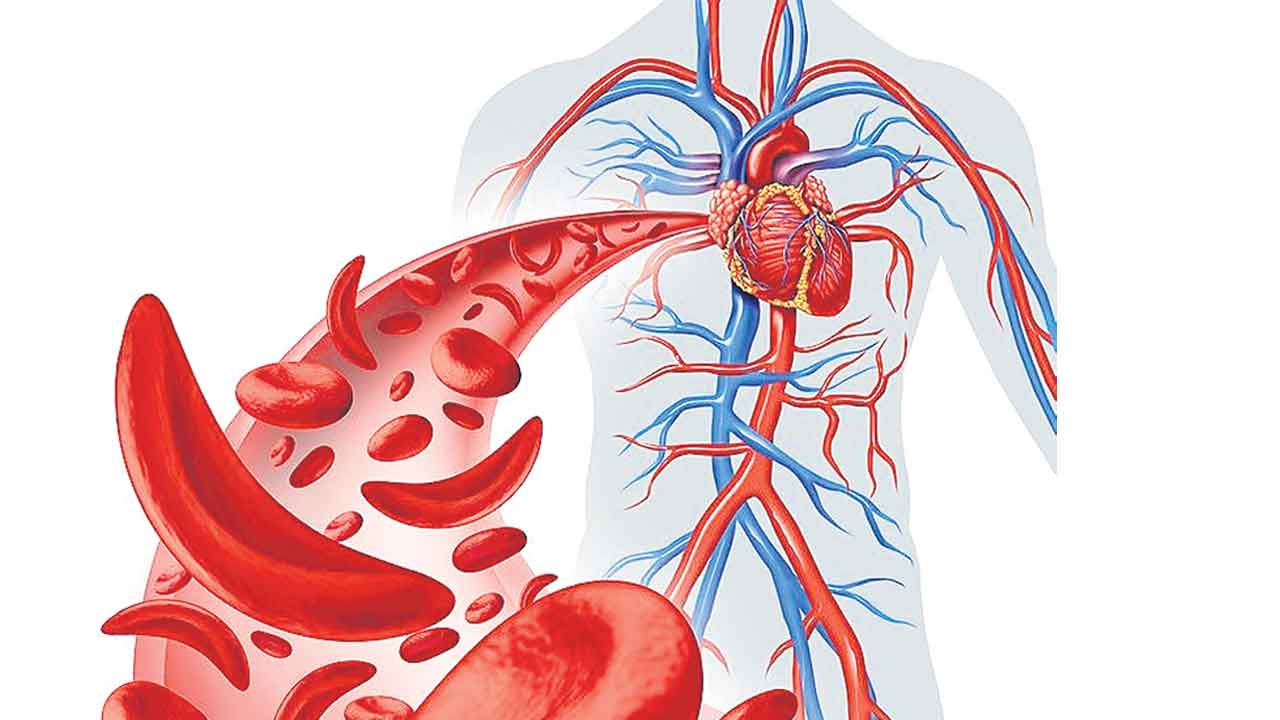 సికిల్‌సెల్‌పై స్పెషల్‌ డ్రైవ్‌