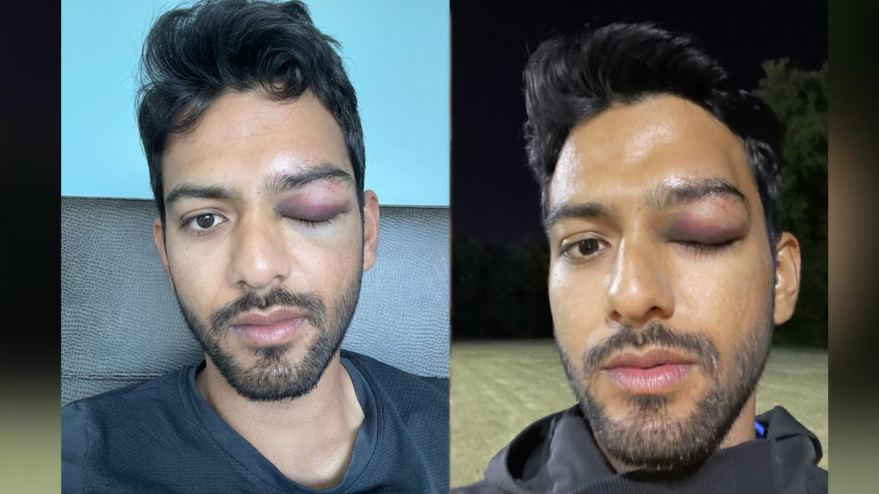 Unmukt Chand | భారత మాజీ క్రికెటర్ ఉన్ముక్త్ చంద్‌ కంటికి గాయం.. కన్ను తెరవలేని పరిస్థితి!