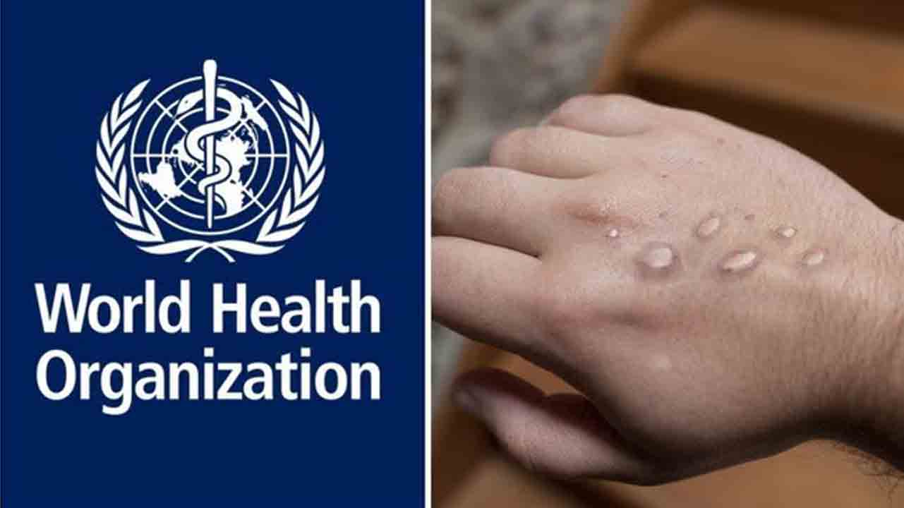 Monkeypox | మంకీపాక్స్‌పై ప్రపంచ ఆరోగ్య సంస్థ హెచ్చరికలు