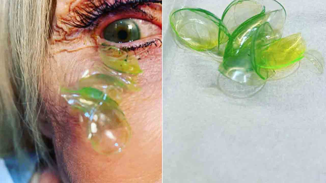 షాకింగ్‌… మహిళ కంట్లో 23 కాంటాక్ట్‌ లెన్స్‌..!