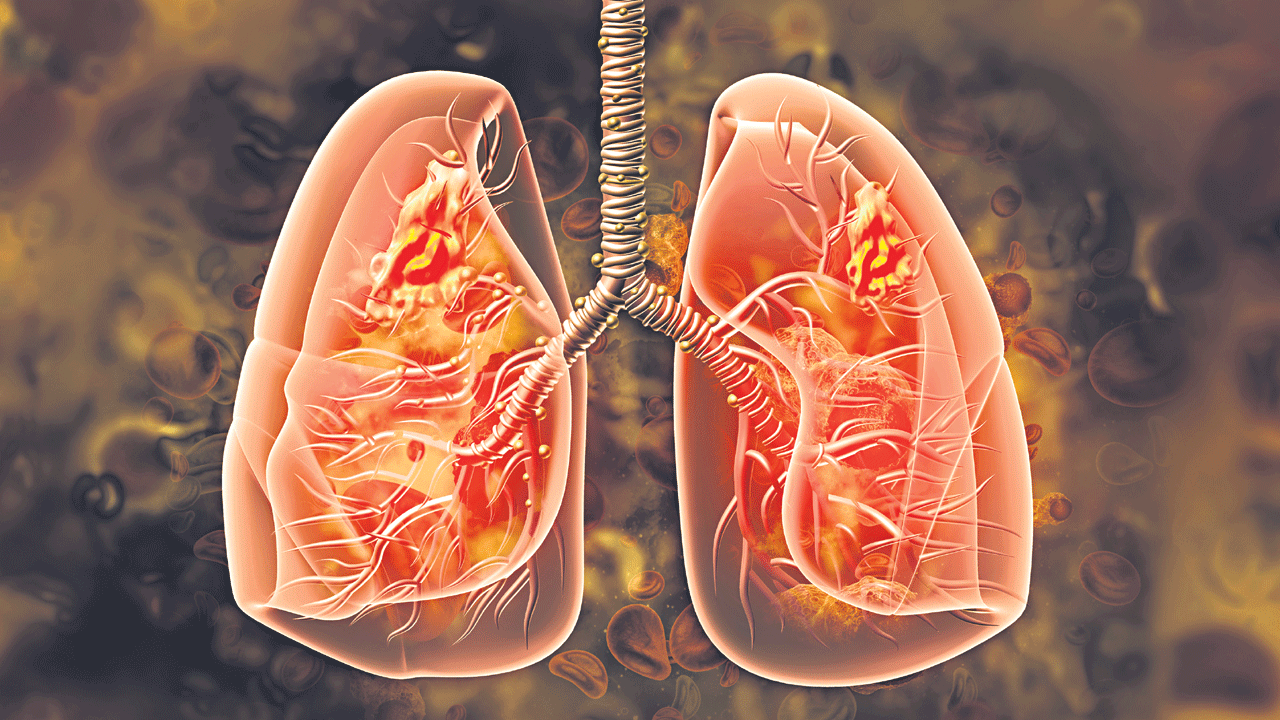 తిత్తులకు..ఊపిరి!