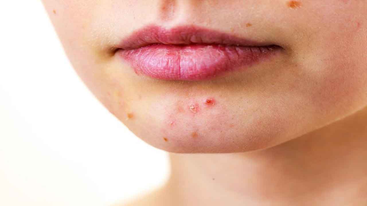 Adult Acne | యుక్త వయసులో మొటిమలా..? నివారణ ఇలా..!