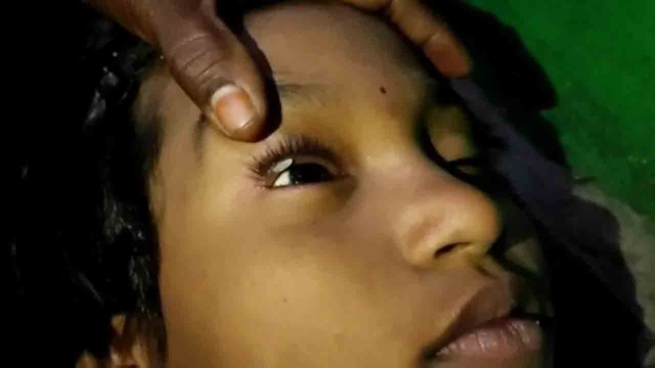 Viral Video | బాలిక కంటిలో నుంచి వస్తున్న రాళ్లు, బియ్యపు గింజలు