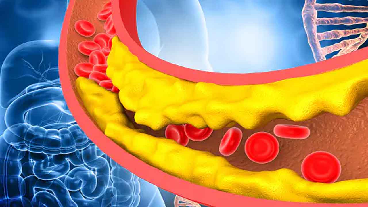 Bad cholesterol | శరీరంలో చెడు కొలెస్ట్రాల్‌ పెరిగిందా..? ఇలా తెలుసుకోండి..!