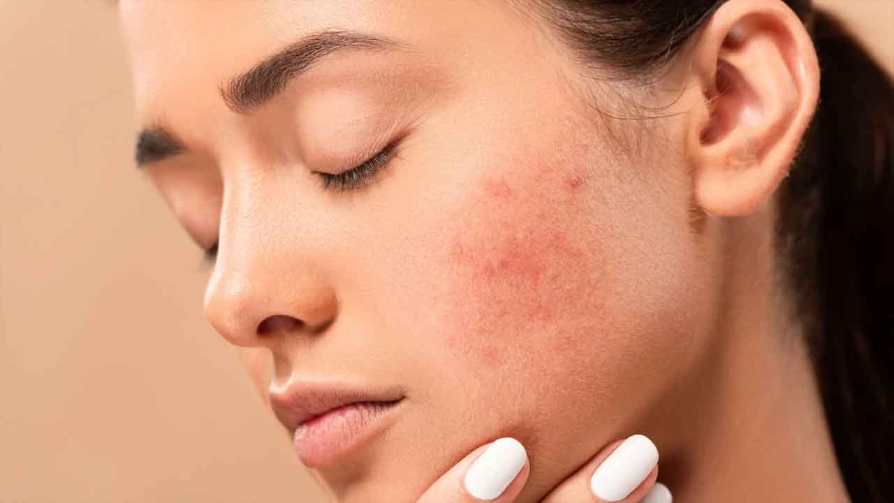 Hormonal Acne | టీనేజర్లలో హార్మోన్‌ మొటిమలు.. ఇలా నివారించుకోండి..!