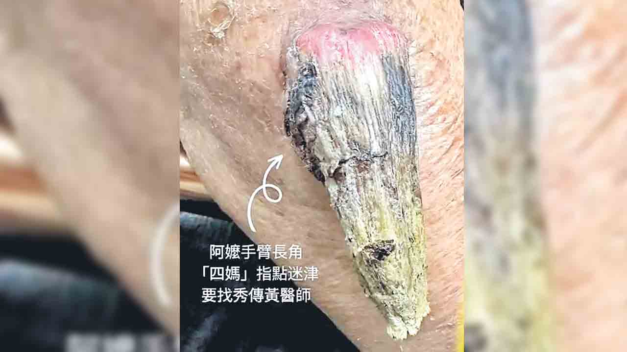 వృద్ధురాలి చేతిపై కొమ్ము!