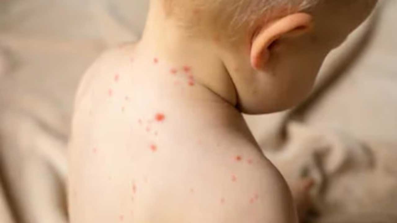 Measles | ఒకరి నుంచి 18 మందికి మీజిల్స్‌ సోకే ప్రమాదం..! హెచ్చరించిన ప్రపంచ ఆరోగ్య సంస్థ..!