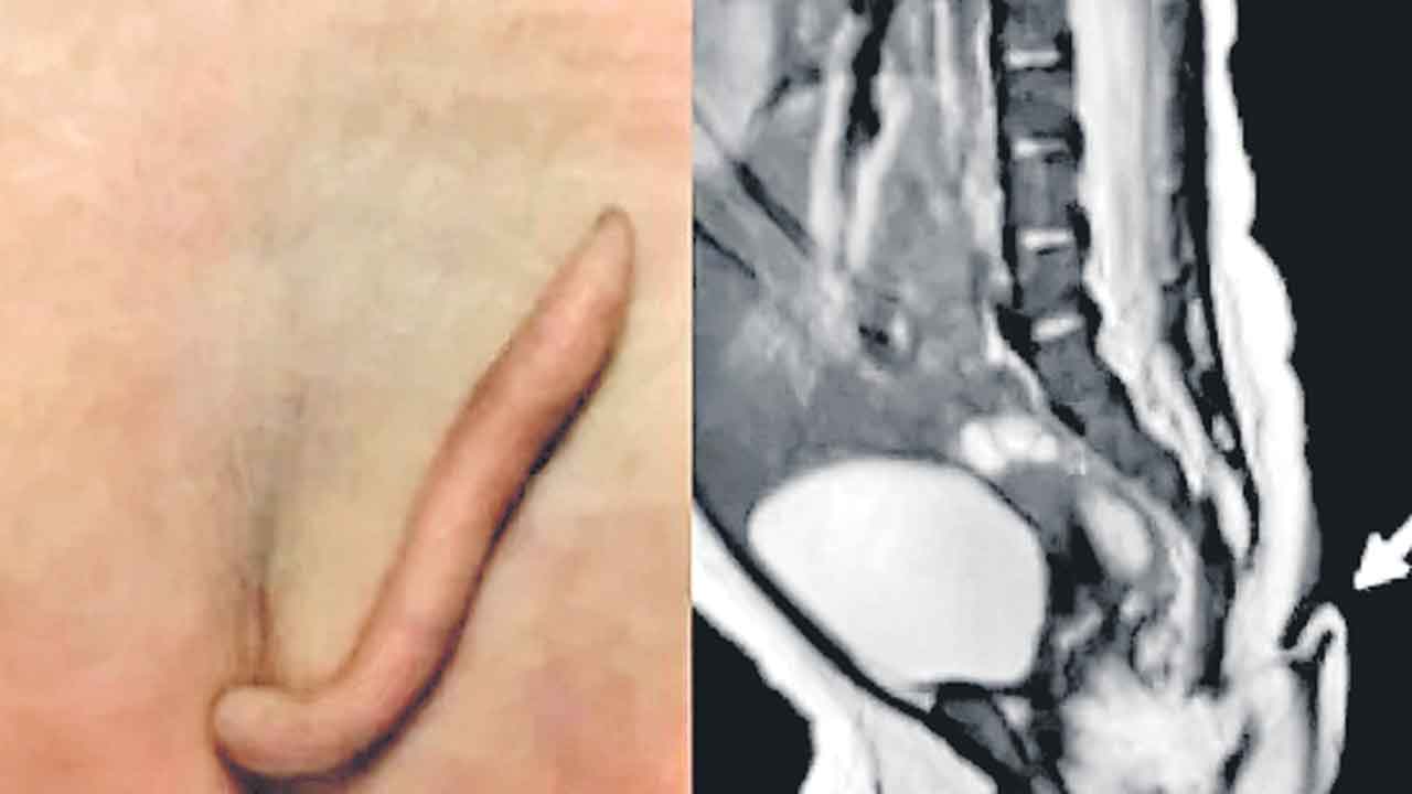 తోకతో పుట్టిన ఆడశిశువు