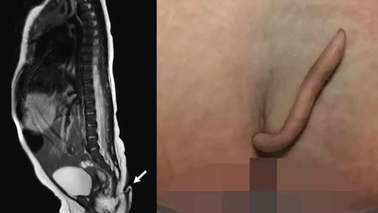 Tailed baby | తోకతో జన్మించిన ఆడ శిశువు.. మెక్సికోలో అరుదైన ఘటన