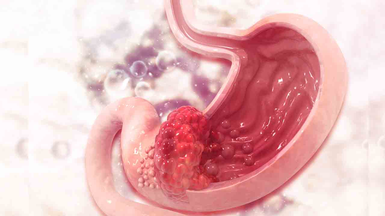 అలాంటి అల్సర్లను అనుమానించాల్సిందే!