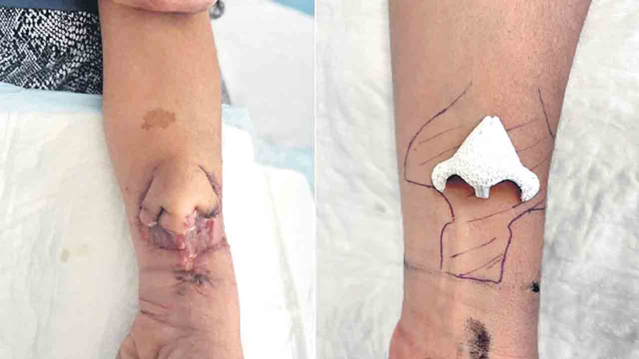 చేతిపై ముక్కును పెంచి.. ముఖానికి అతికించారు!