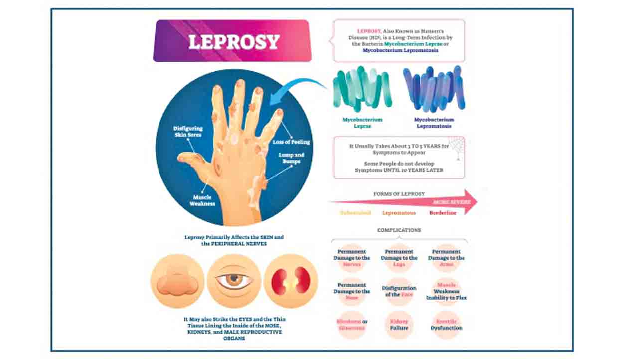 కుష్టు వ్యాధి కట్టడికి..