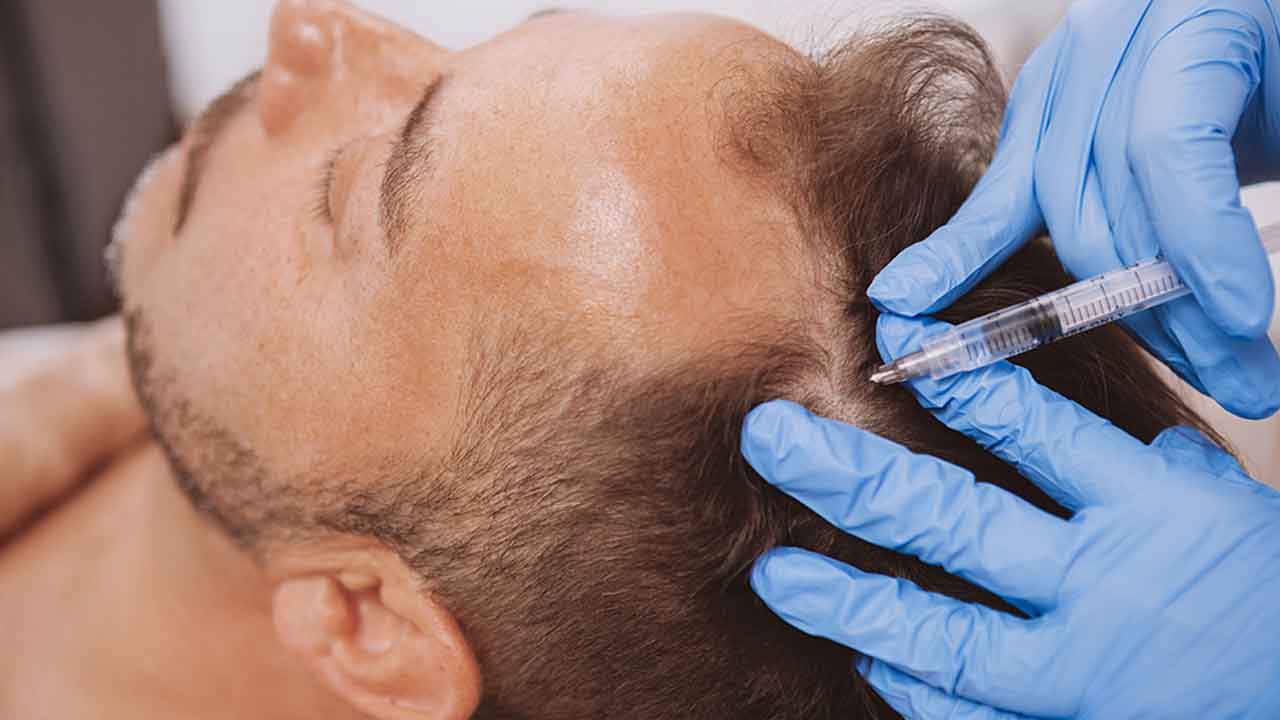 హెయిర్‌ ట్రాన్స్‌ప్లాంట్‌ వికటించి!