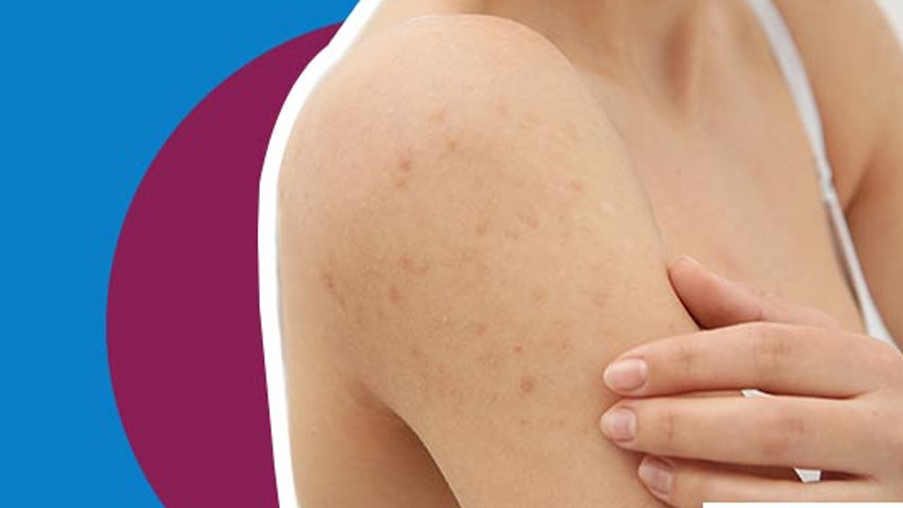 బ్లాక్‌ హెడ్స్ వేధిస్తున్నాయా.. అయితే ఈ చిట్కాలతో చెక్‌ పెట్టండి