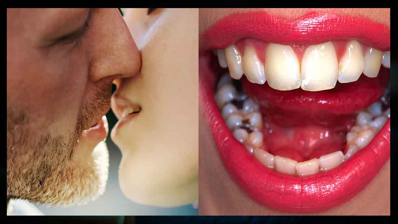 Kiss and Cavities | ముద్దులతో డెంటల్‌ క్యావిటీస్‌ వస్తాయా..? నిజమా..!