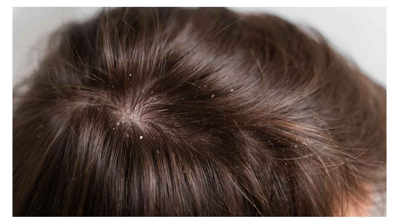 Dandruff @ Winter | చలికాలంలో చుండ్రు సమస్యలు.. ఇలా పరిష్కరించుకోండి..!