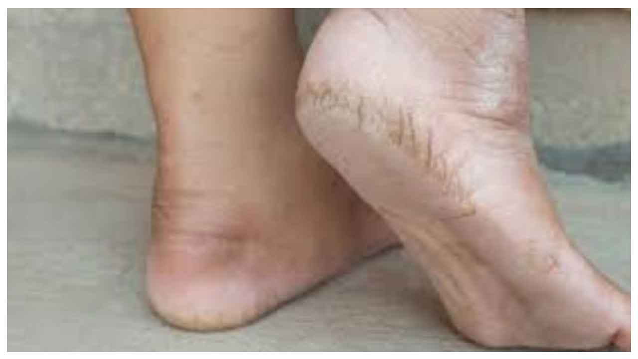 Cracked Heels | చలికాలంలో మడమలు పగులుతున్నాయా..? ఇవిగో ఇంటి వద్ద పరిష్కార మార్గాలు..!