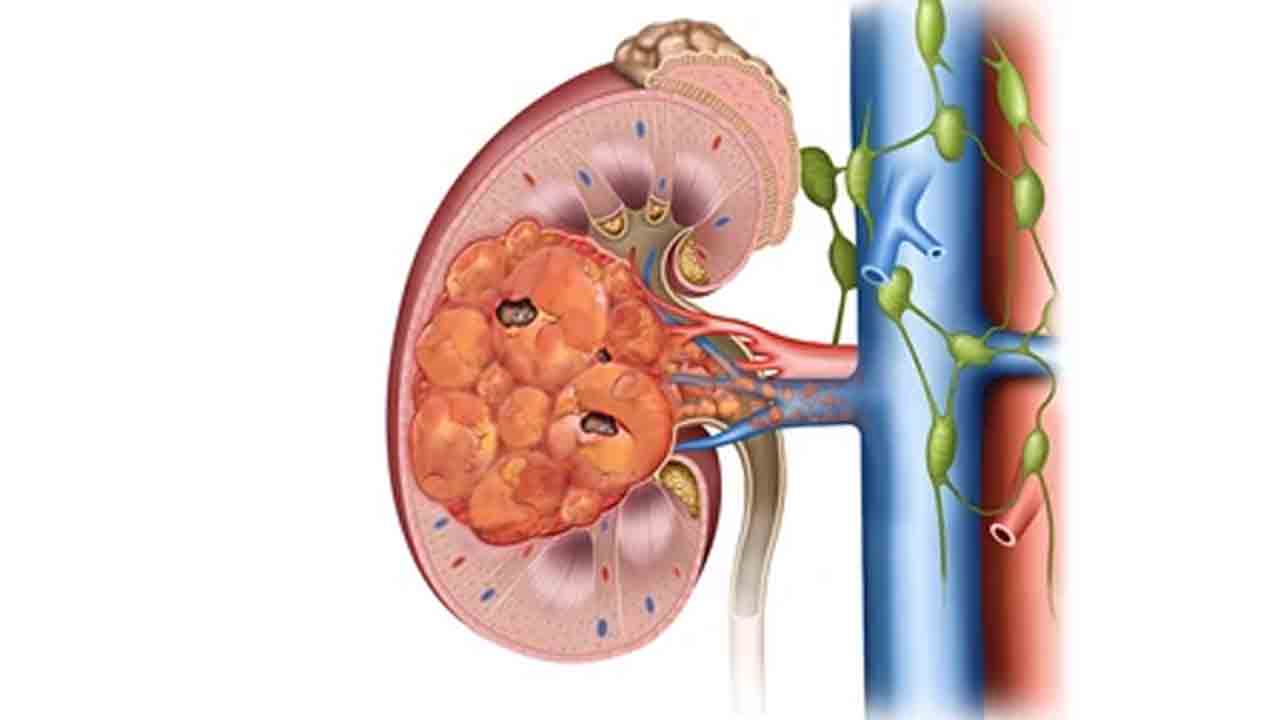 మద్యపానం, ధూమపానంతో కిడ్నీ ట్యూమర్లు