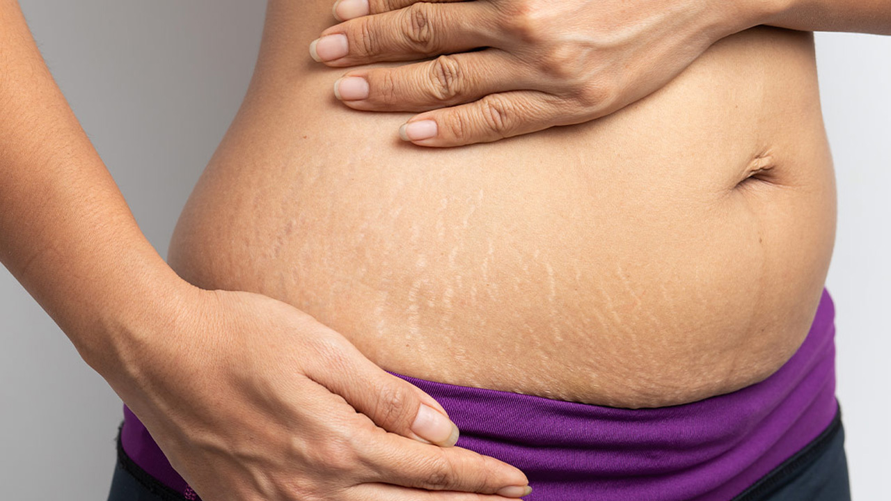 స్ట్రెచ్‌ మార్క్స్‌ వేధిస్తున్నాయా.. అయితే ఈ వంటింటి చిట్కాలు మీ కోసమే