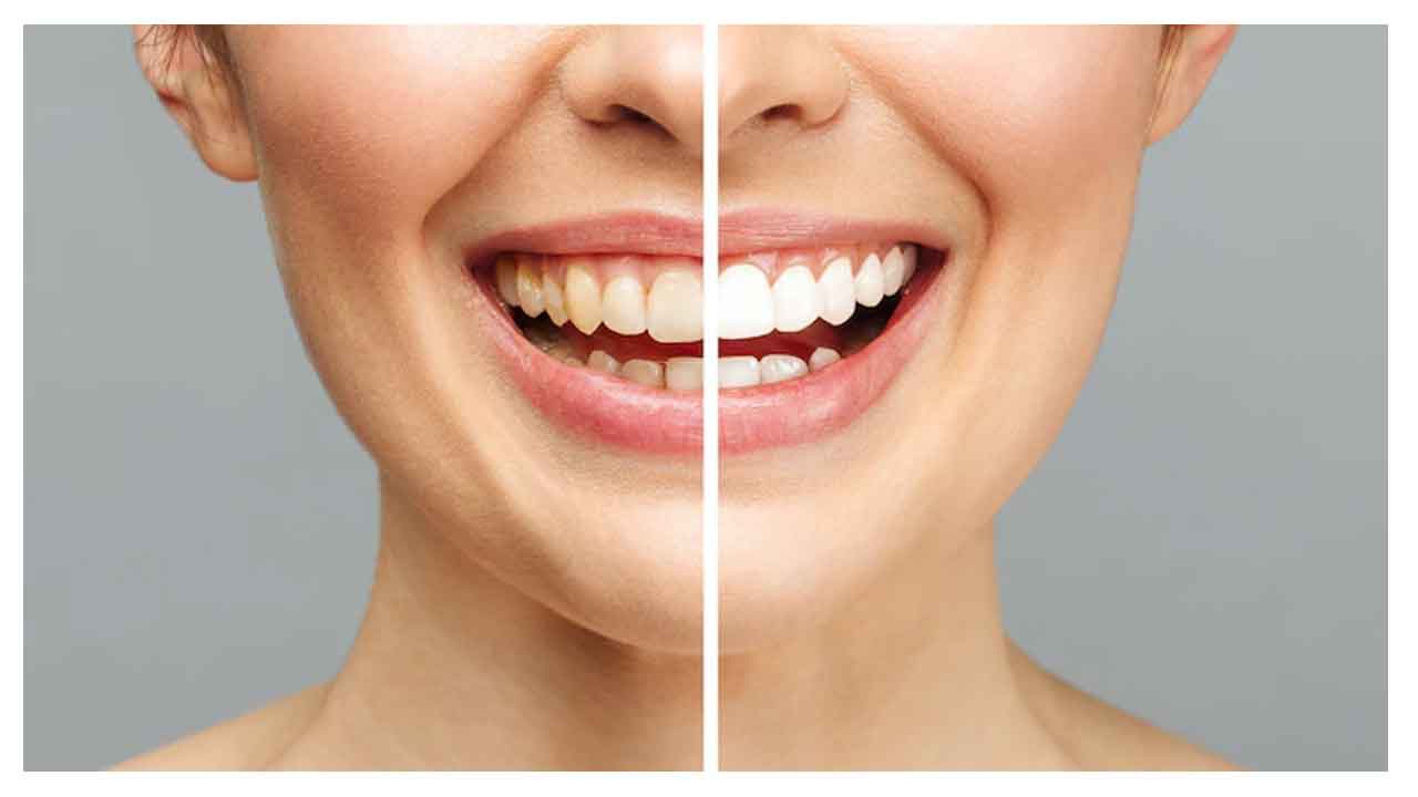 White Teeth | దంతాలు తెల్లగా ఉంటేనే మనం ఆరోగ్యంగా ఉన్నట్లా..? పసుపు రంగు పళ్లు అనారోగ్య సూచికలా?