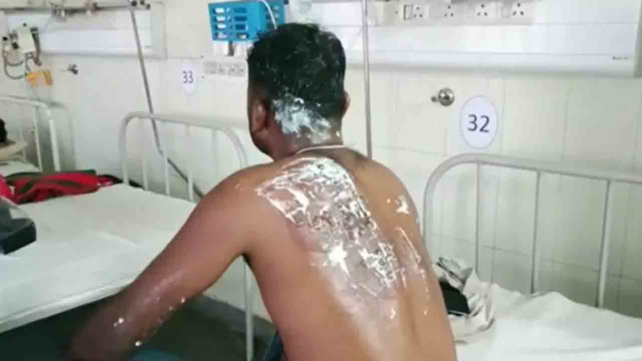 రుణ వాయిదా చెల్లించమని అడిగిన ఫైనాన్స్ కంపెనీ సిబ్బందిపై.. వేడి నూనెతో దాడి