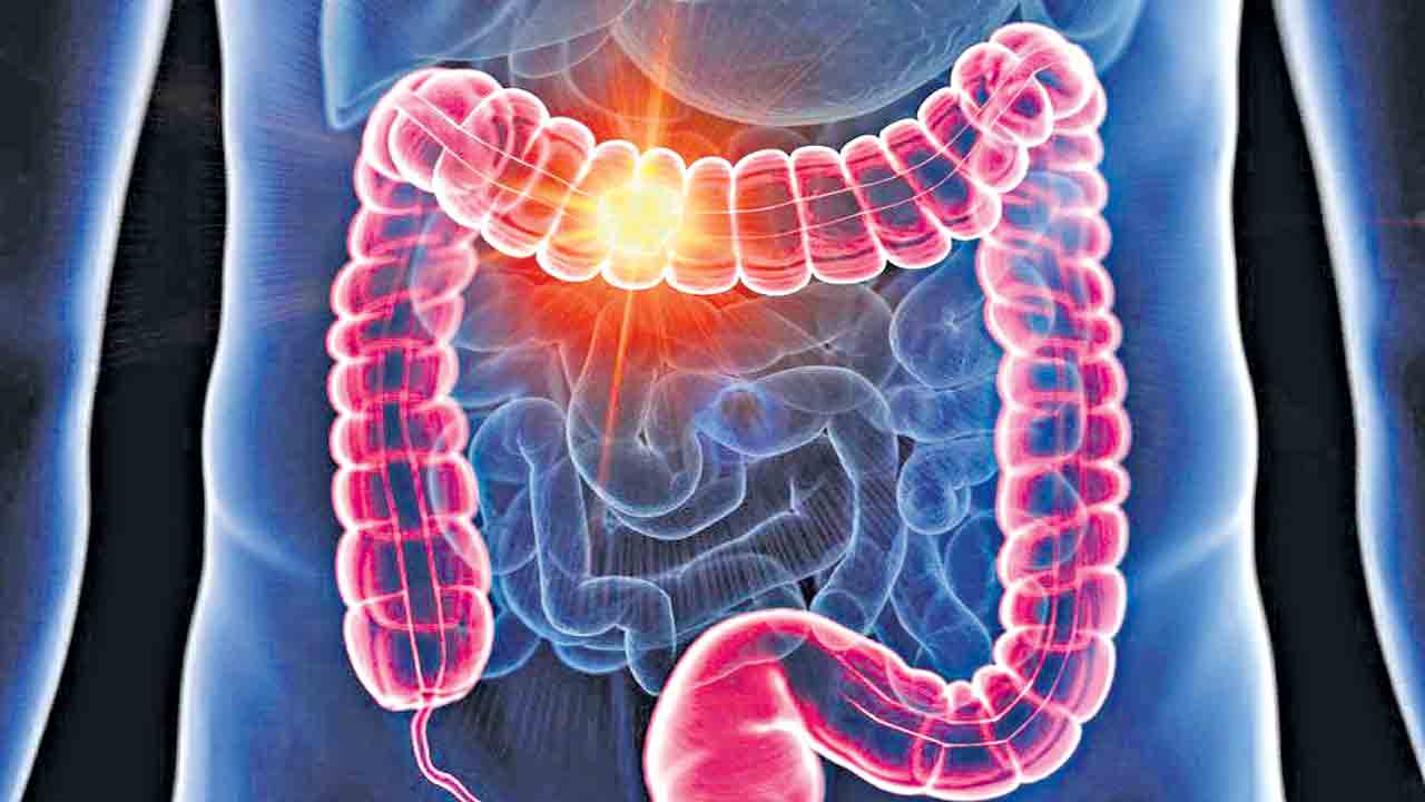 పెద్ద పేగు క్యాన్సర్‌ గుట్టువీడింది!