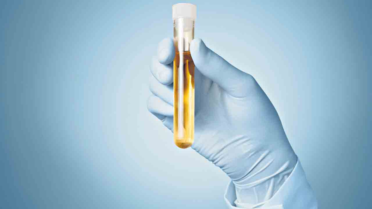 మూత్ర పరీక్షతో అల్జీమర్స్‌ గుర్తింపు