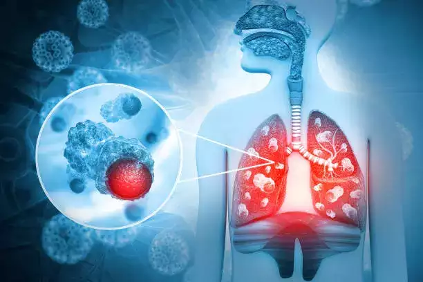 Lung Cancer : క‌ల‌వ‌ర పెడుతున్న ఊపిరితిత్తుల క్యాన్స‌ర్.. అత్య‌ధిక కేసులు ఈ రాష్ట్రాల్లోనే