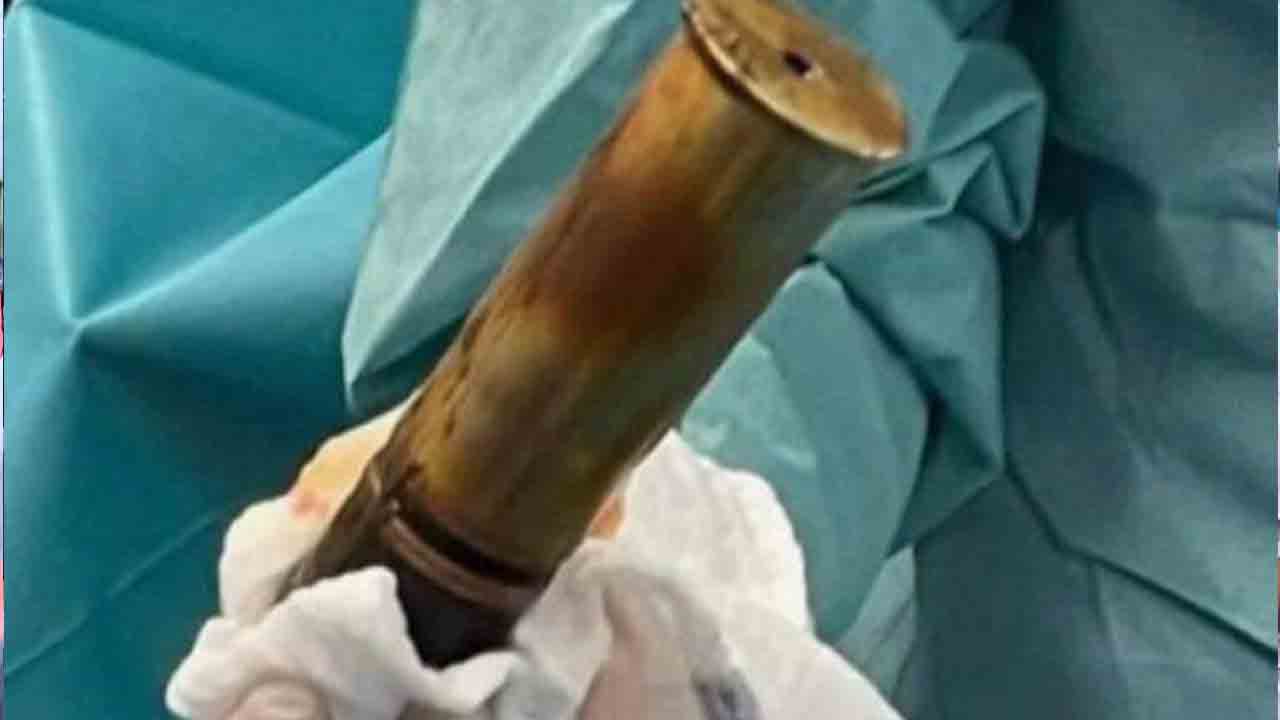 శృతి మించిన కోరిక‌లు.. పురీష‌నాళంలో 8 ఇంచుల ఫిరంగి గుండు..