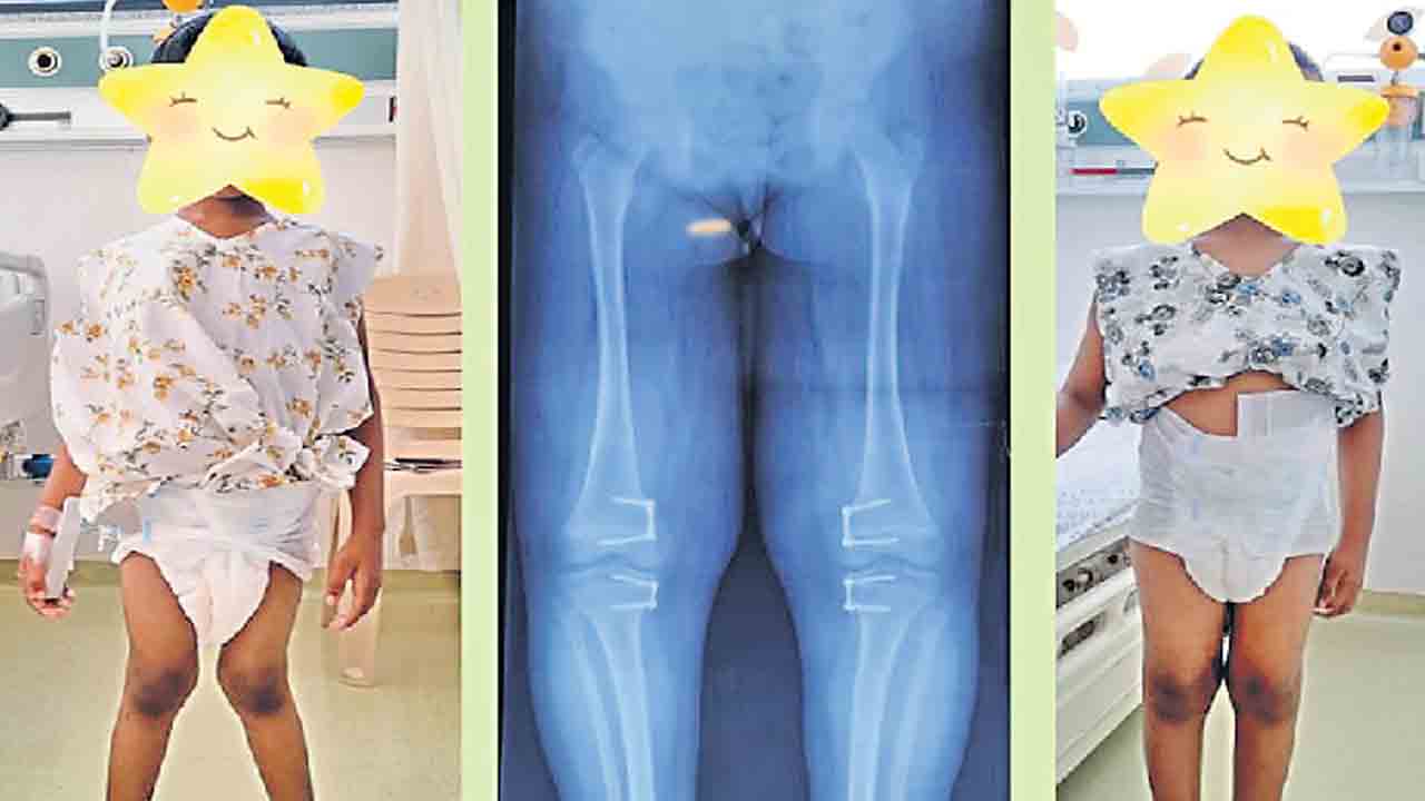 ఎముకల్లో లోపం.. ఎదుగుదలకు శాపం!