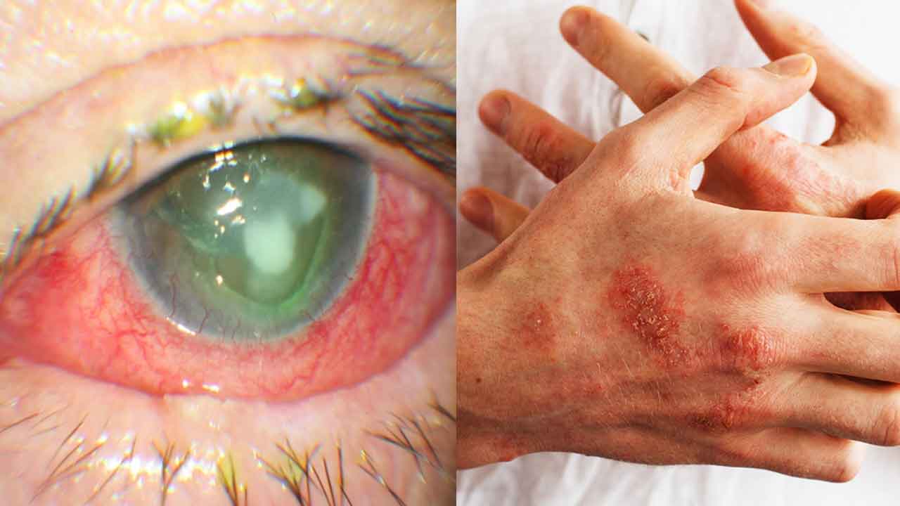 Fungal Infection | ఫంగస్‌.. యమ డేంజరస్‌..! ఫంగల్‌ ఇన్‌ఫెక్షన్ల పెరుగుదలపై నిపుణుల ఆందోళన