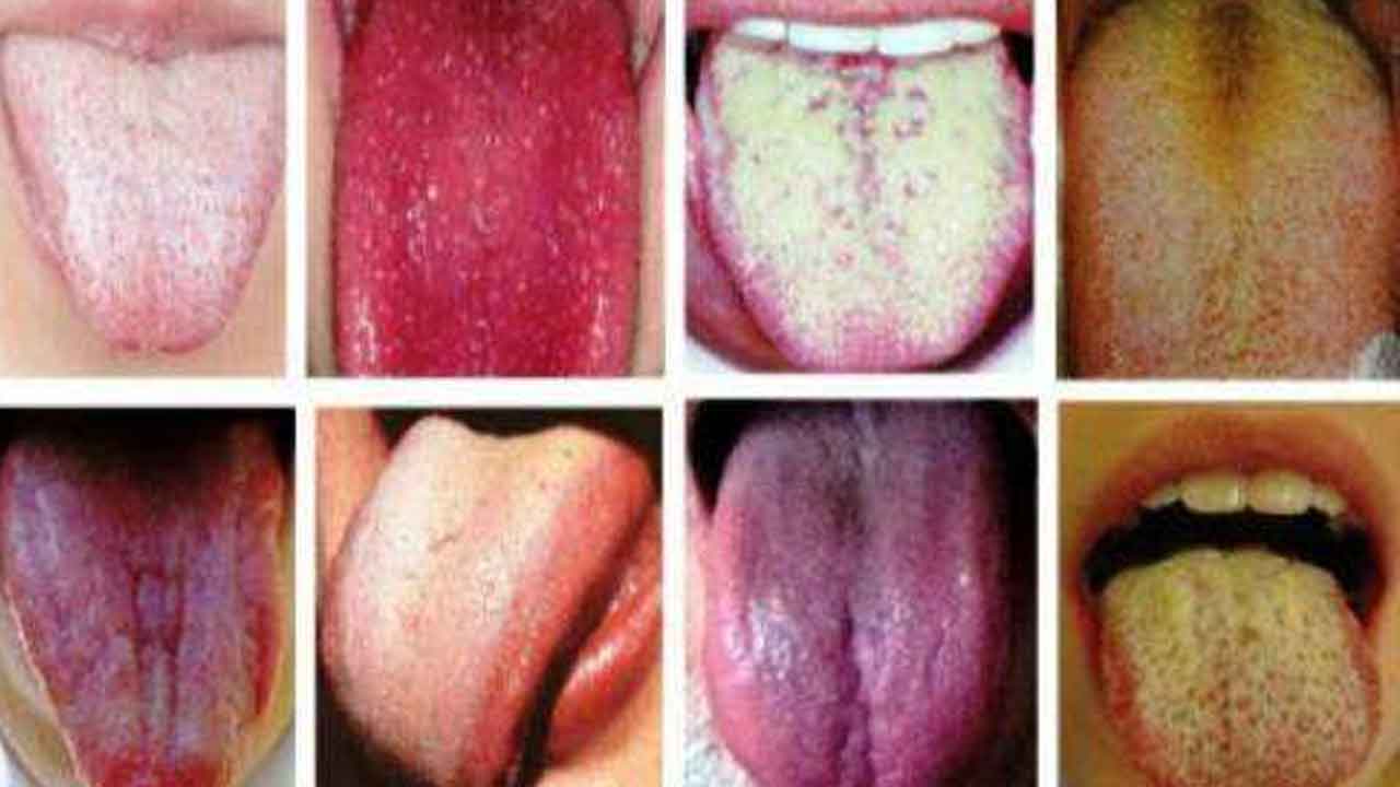 Tongue @ Diseases | ఆరోగ్యానికి అద్దం – నాలుక.. ఎన్నో రోగాల్ని ఇట్టే చెప్పేస్తుంది..!