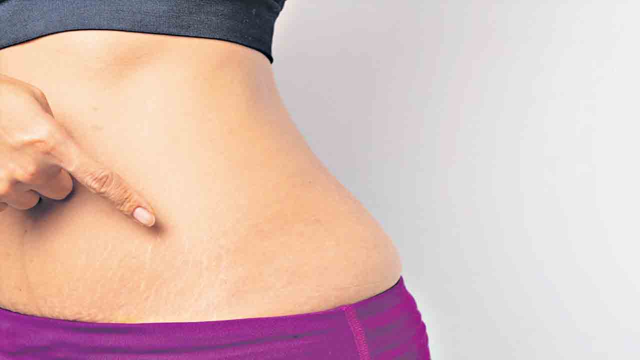 స్ట్రెచ్‌ మార్క్స్‌ పడకుండా ఉండాలంటే..