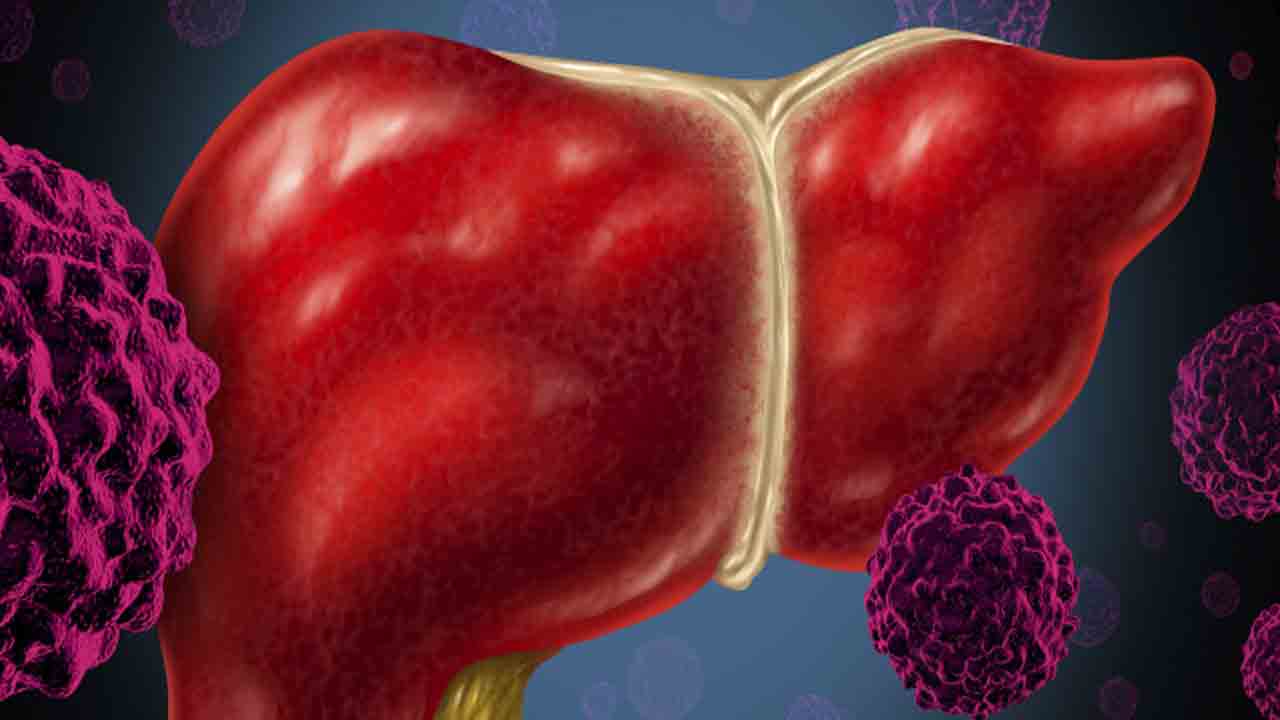 కాలేయ క్యాన్సర్‌కు దారితీస్తున్న హెపటైటిస్‌