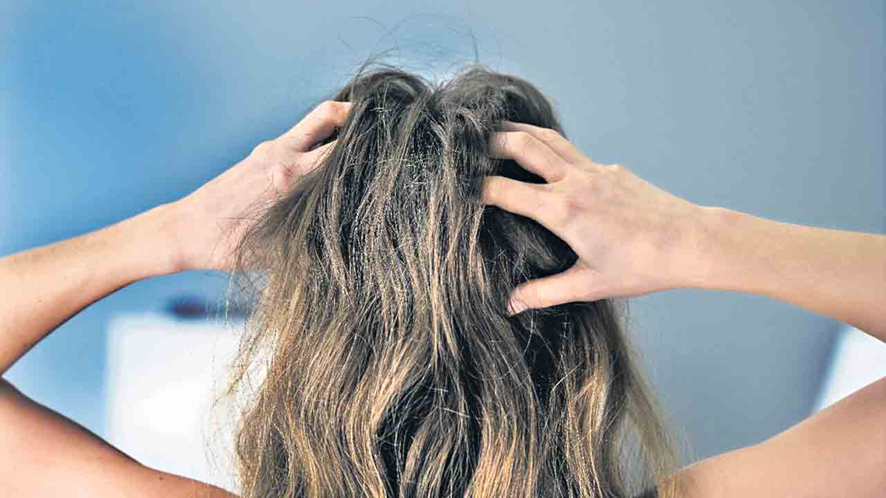 చుండ్రుకు సవాల్‌!  (యాపిల్‌ సైడర్‌ వెనిగర్‌)