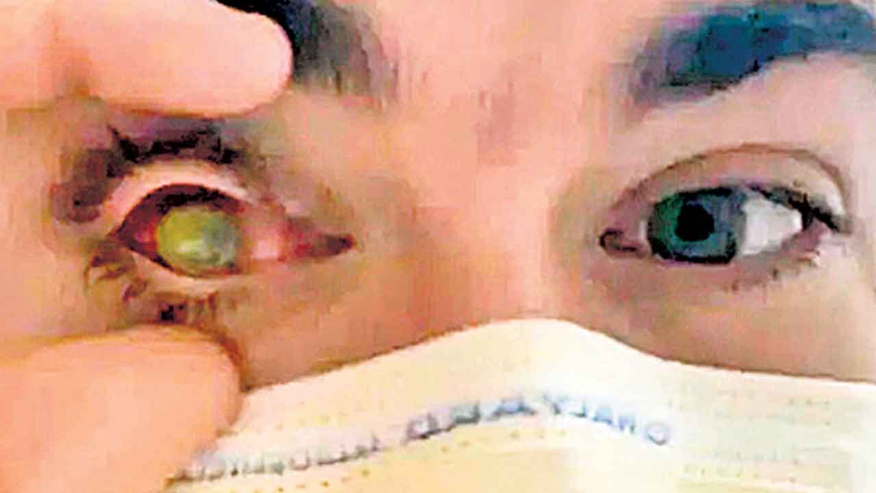 Contact Lenses | కాంటాక్ట్‌ లెన్స్‌తో పడుకుంటే కంటిని తినేసింది !