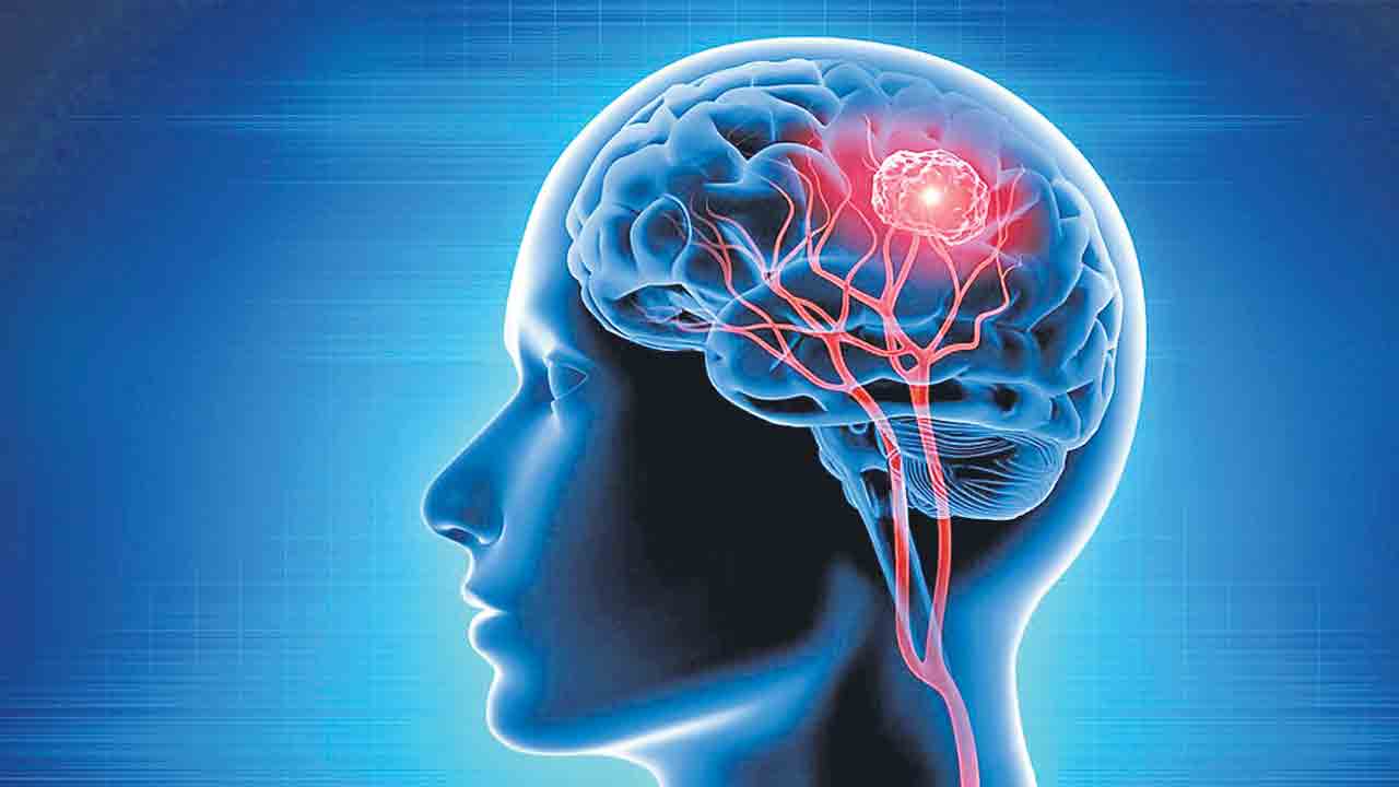 మూత్ర పరీక్షతో మెదడు కణితుల గుర్తింపు