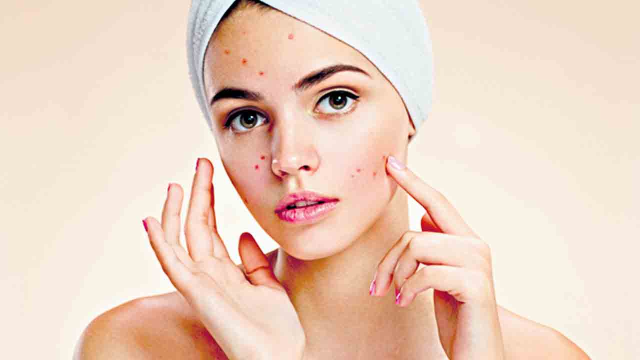 మొటిమలకు.. మందు ఉందా?