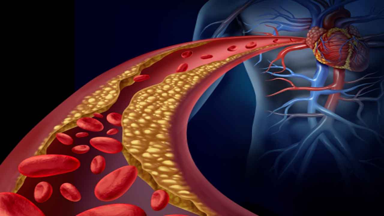 High Cholesterol | కొలెస్ట్రాల్‌ పెరిగిందా..? ఈ చిట్కాలు పాటించి తగ్గించుకోండి..!