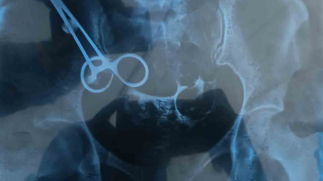 Doctor | మహిళ కడుపులో కత్తెర మరిచిపోయిన డాక్టర్‌.. ఆరేళ్ల తర్వాత వెలుగులోకి