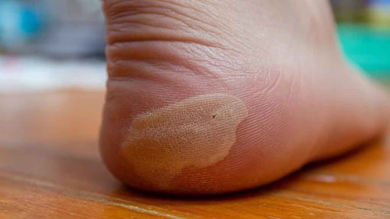 Diabetic Foot | ఇవీ డయాబెటిక్‌ ఫుట్‌ లక్షణాలు.. వీటిని అసలే విస్మరించవద్దు..!