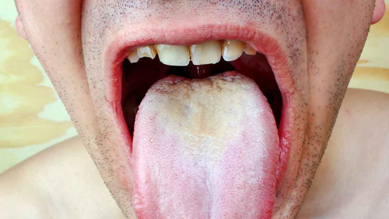 White tongue | నాలుక తెలుపు రంగులోకి మారిందా..? అయితే, ఈ అనారోగ్యంగా అనుమానించాల్సిందే..!