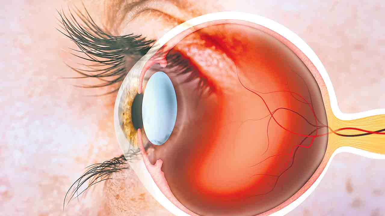 Retinopathy of Prematurity | పిల్లలను భయపెట్టిస్తున్న రెటీనా సమస్యలు.. పుట్టిన నెలలోపు గుర్తించకపోతే శాశ్వత అంధత్వమే