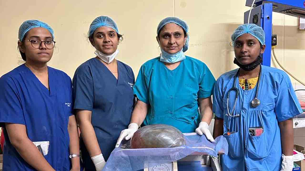 గాంధీలో నిరుపేద యువతికి క్లిష్టమైన శస్త్రచికిత్స.. 7.5 కిలోల ఒవేరియన్‌ కణతి తొలగింపు