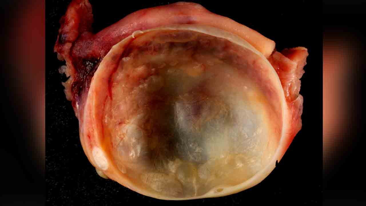 Ovarian cyst | మ‌హిళ క‌డుపులో నుంచి 10.6 కేజీల అండాశ‌య తిత్తి తొల‌గింపు