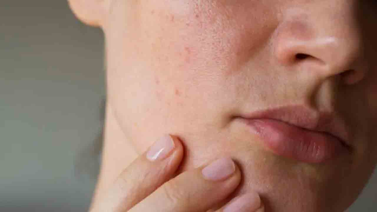 Beauty Tips | చర్మంపై నల్ల మచ్చలు చికాకు పెడుతున్నాయా.. అయితే ఈ సింపుల్ టిప్స్ మీ కోసమే..