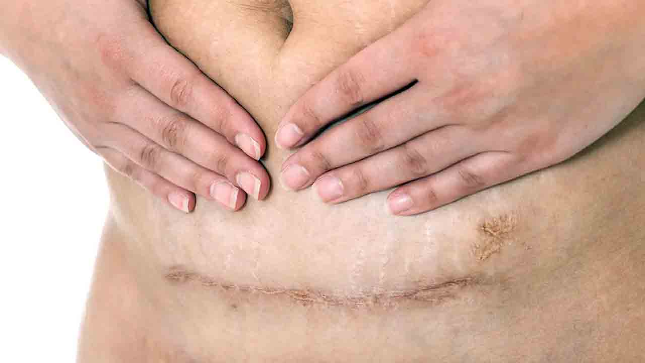 Pregnancy | మొదటి డెలివరీ సిజేరియన్‌ అయితే.. రెండోది నార్మల్‌ అవ్వదా?