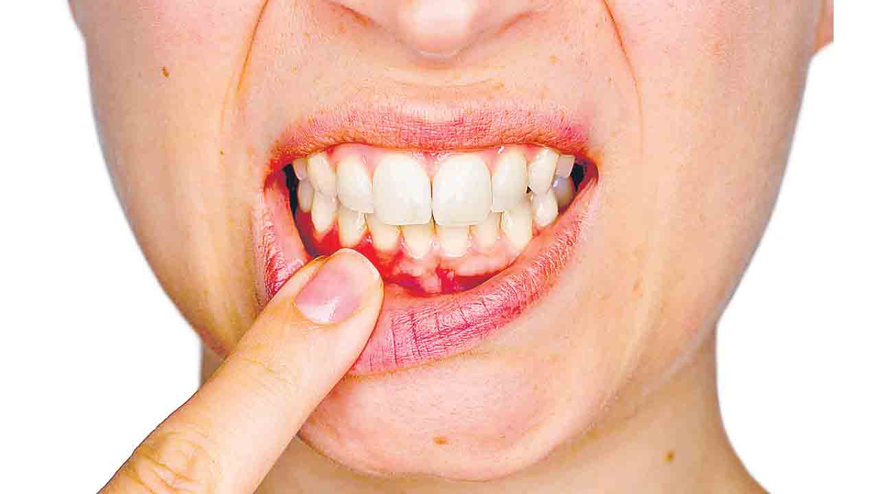 Oral Health | చిగుళ్ల నుంచి రక్తం కారుతోందా? అయితే ఈ అనారోగ్య సమస్యలతో బాధపడుతున్నట్లే !!