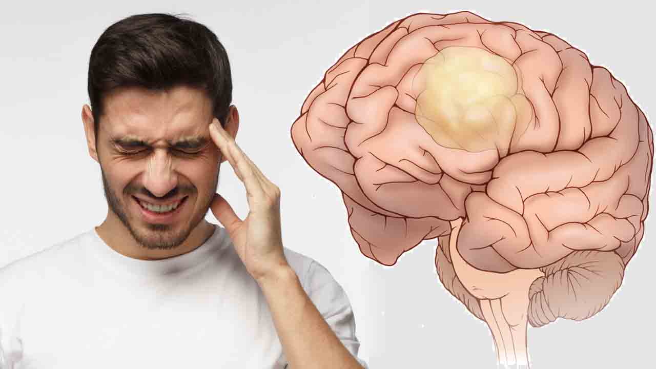 మెదడుపై వార్‌.. బ్రెయిన్‌ ట్యూమర్‌!