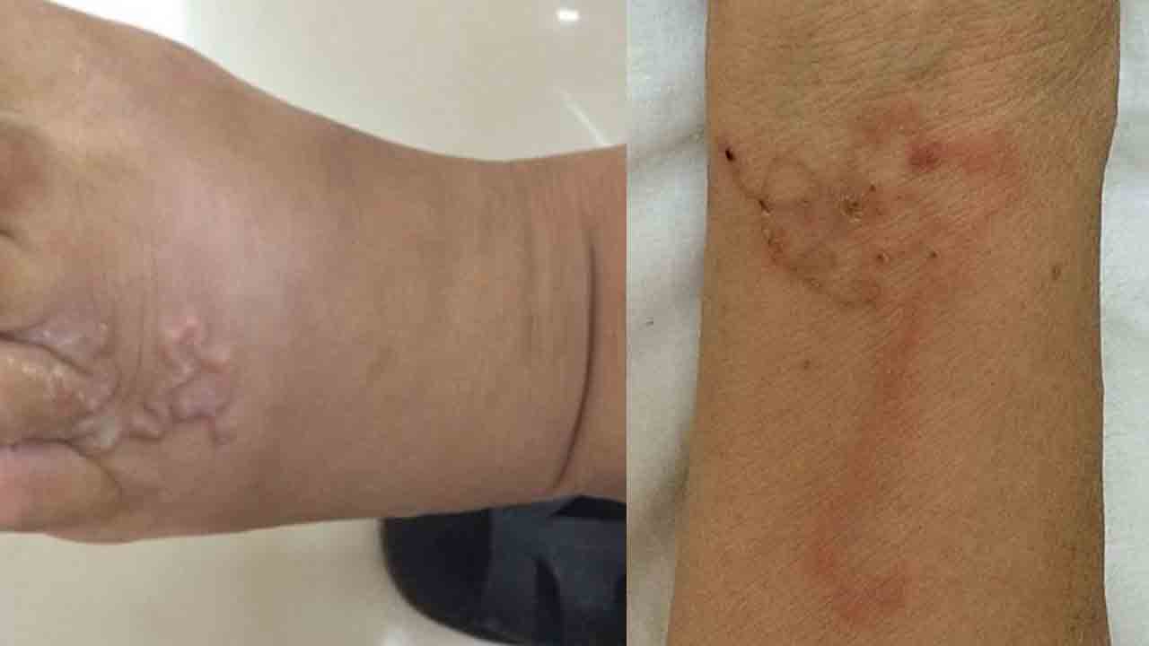 Prasitic worms | మహిళ చర్మం కింద నులిపురుగులు.. మెదడులోనూ పురుగుల గూడు.. ఎందుకలా జరిగిందంటే..!